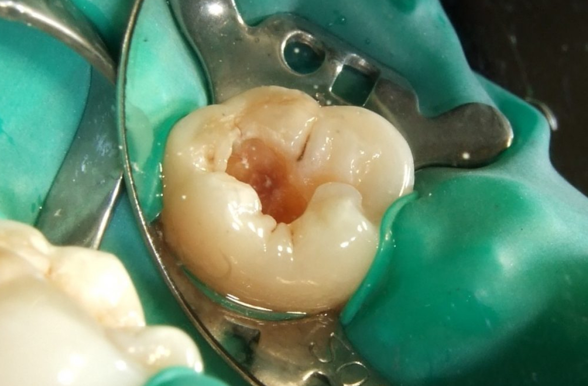 Root Canal Treatment + Dental Filling Image