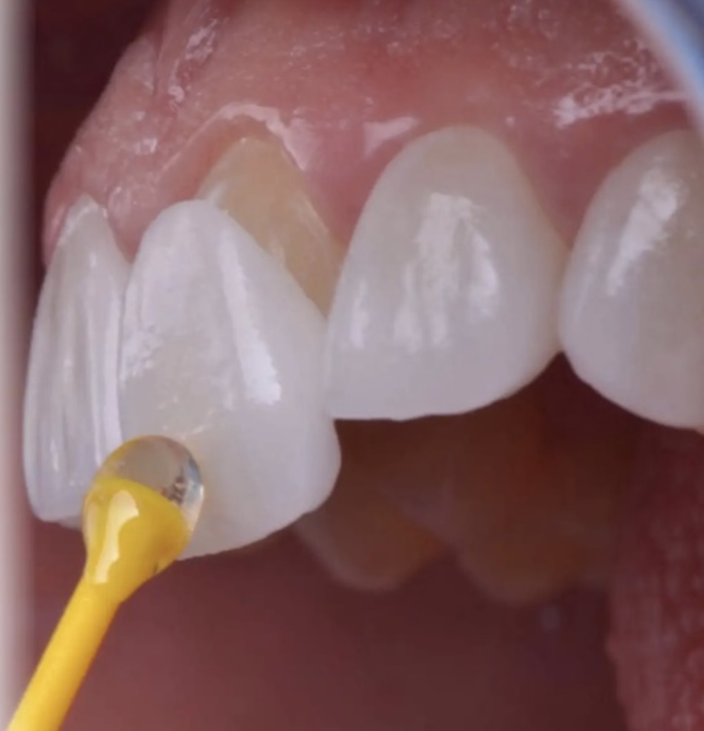 Dental Veneers Image