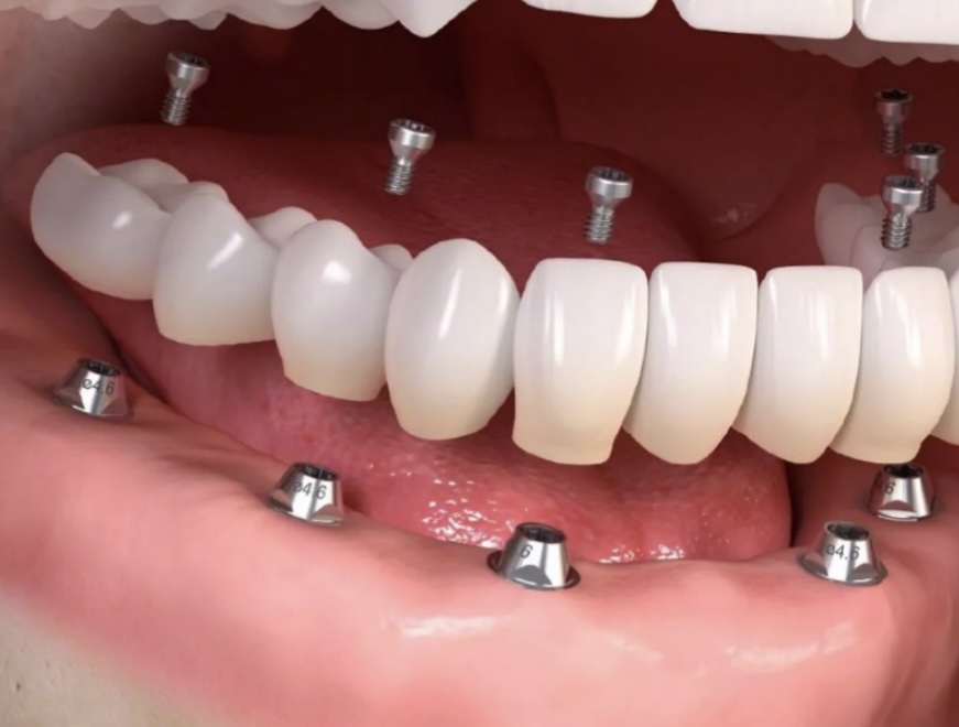 Dental Implants, All-on-4 & All-on-6 Image